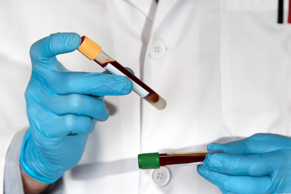 A gloved clinician holds two labeled blood sample tubes side by side for comparison.