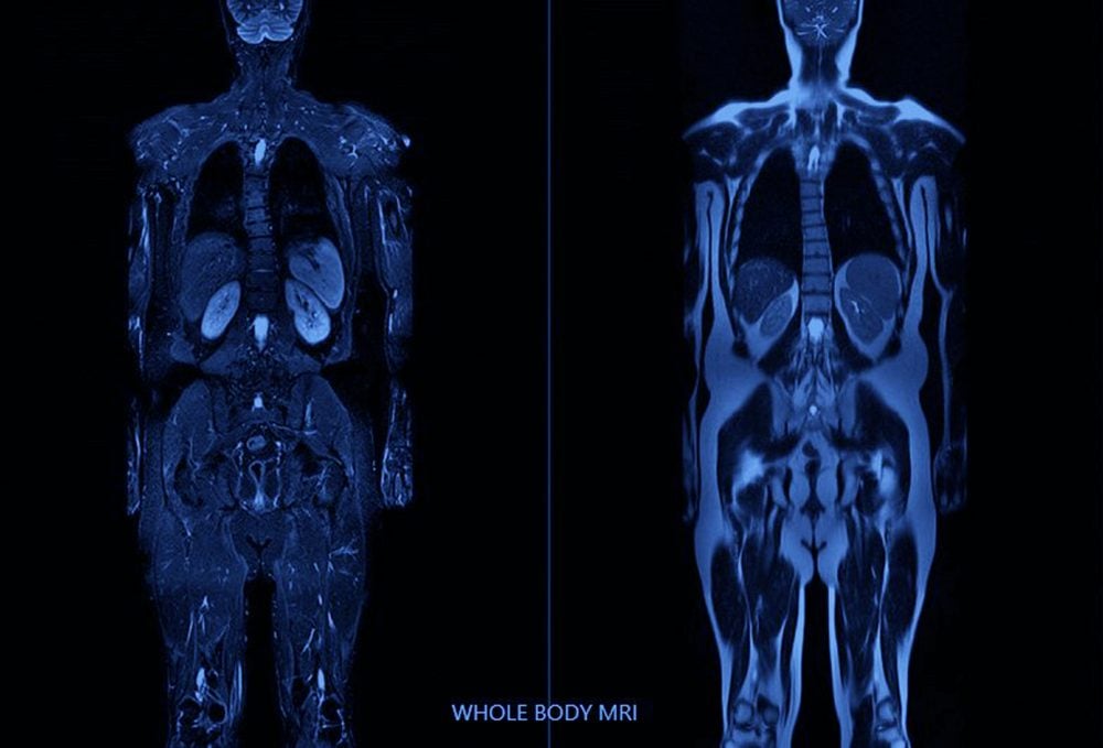 Two blue-toned coronal MRI scans of a full body appear side by side labeled Whole Body MRI.